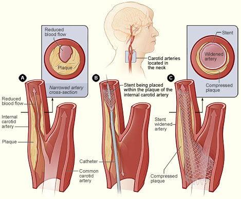 Carotid Artery Angioplasty and Stenting